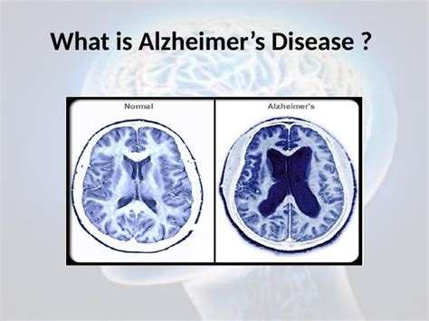 Alzheimer’s Disease: Symptoms, Stages, Diagnosis and Treatment