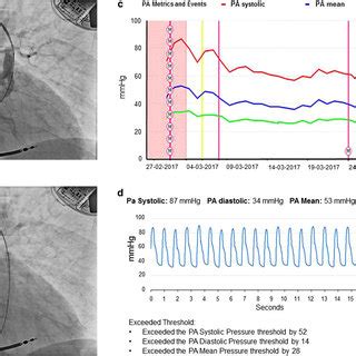 CardioMEMS implantation and data read-outs. a Pulmonary arteriography... | Download Scientific ...