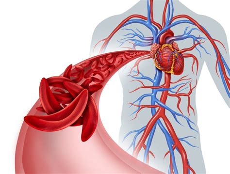 Clinical Efficacy Of Non Pharmacological Therapy For Sickle Cell