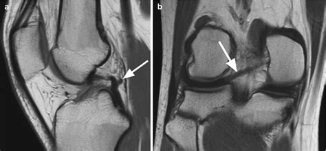 Anterior Meniscofemoral Ligament