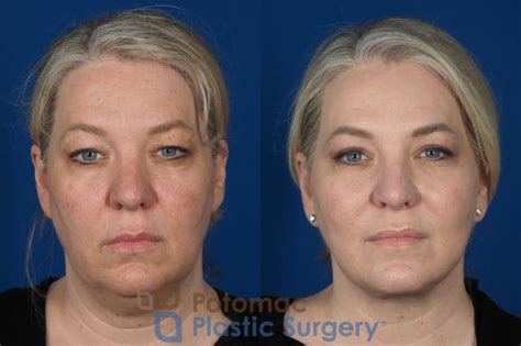 Facial Sculpting Before After Photo Gallery Washington Dc