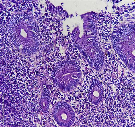 Sigmoid Colon Colonoscopic Biopsy Chronic Nonspecific Colitis Show Colonic Mucosa Chronic