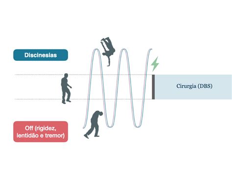 Cirurgia Na Doença De Parkinson Saiba Quando Ela é Indicada Dr