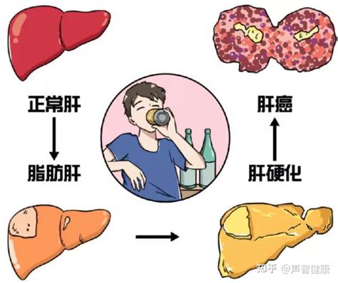 脂肪肝也可能癌变再不注意身体出现这些信号时就成晚期了 知乎