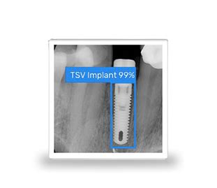 Trate Ag Compressive Implant Dentaire Spotimplant