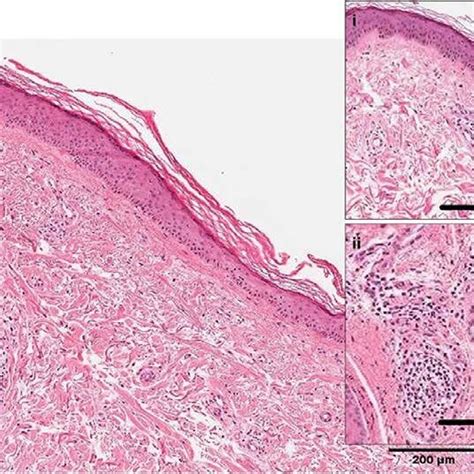 Histology On Skin Biopsies H E Staining Corresponding To Banff Grade 3