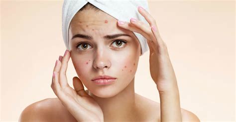 Угри на лице картинки (Большая коллекция изображений) - artshots.ru