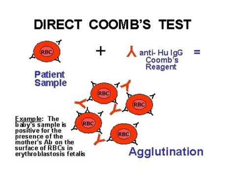 The Coombs Test Newborn Nursery Stanford Medicine