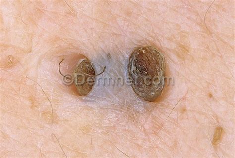 Hidradenitis Suppurativa Photo Skin Disease Pictures