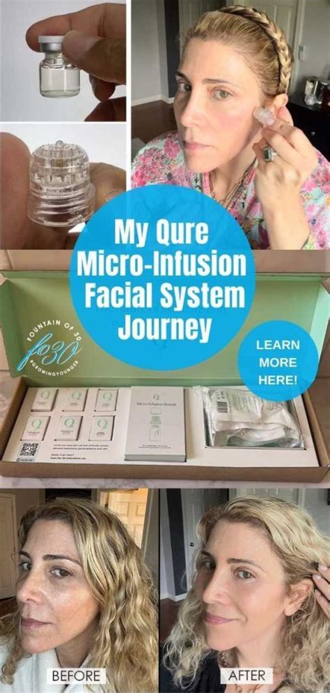 Qure Micro Infusion Facial System Gives You Microneedling Results At