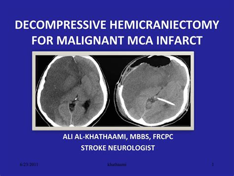 Decompressive Hemicraniectomy For Malignant Mca Rm Solutions