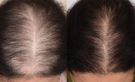 natural treatment  address hair loss mooresville dermatology