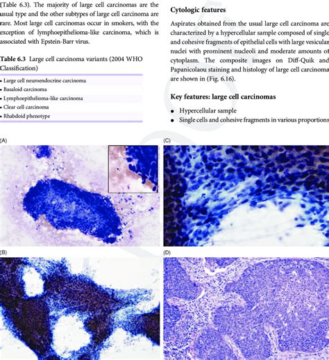 14 Squamous Cell Carcinoma Moderately Differentiated Non Keratinizing