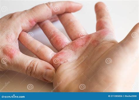 Strong Allergic Eczema On Hands Red Cracked Skin With Blisters Stock