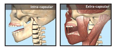 Myosa