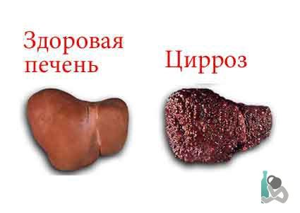 Печень и алкоголь - почему, лечение, восстановление - peofranlemre