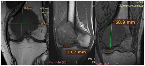 Measurement Of Morphological Parameters Of Giant Cell Tumor Of Bone In