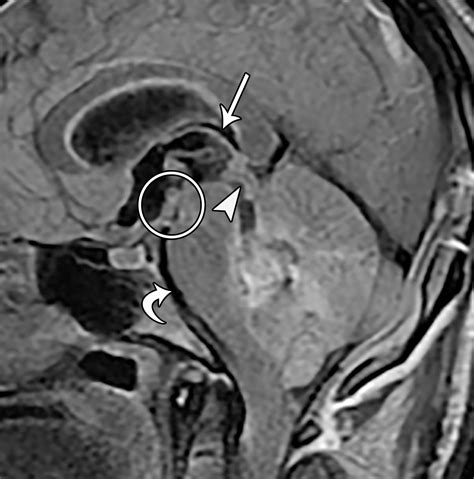 Types Of Cerebral Herniation And Their Imaging Features Radiographics