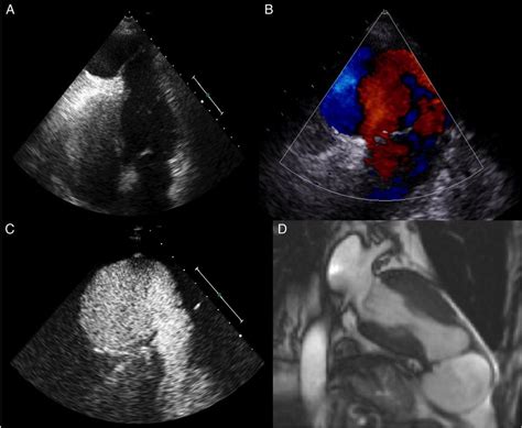 A Transthoracic Echocardiogram Four Chamber View B Colour Doppler