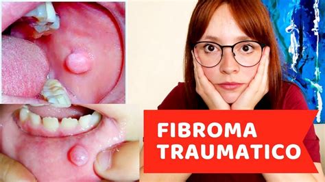 Fibroma Mole