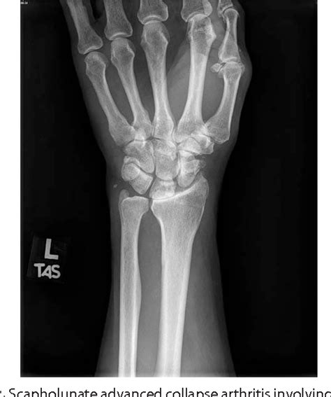 Osteoarthritis Of The Wrist Semantic Scholar