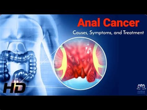 Anal Cancer Facts What Causes It And How To Fight It Youtube