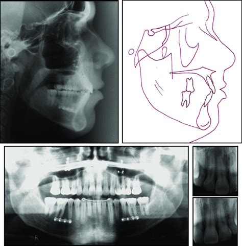 Posttreatment Lateral Radiograph Lateral Cephalometric Radiograph And