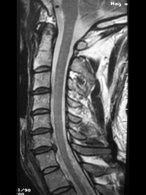 Resonancia Magn Tica Columna Cervical Hernia Discal Aire Mb