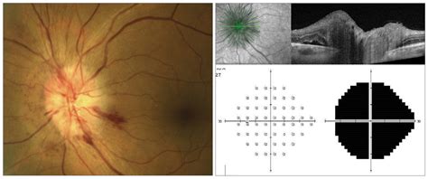 Neuritis, NAION Main Causes for Optic Disc Edema