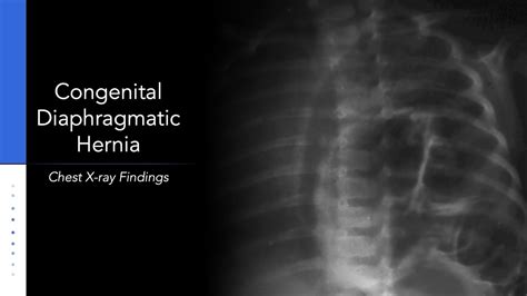 Congenital Diaphragmatic Hernia