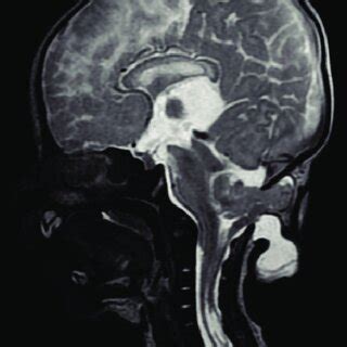 Descent Of Brainstem & Cerebellar Tonsils Causing Crowding At Foramen ...