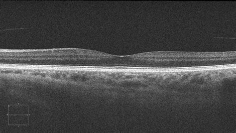 normal OCT - Applecross Eye Clinic