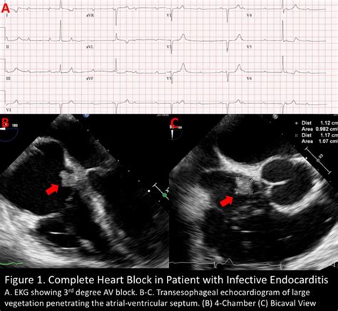 Endocarditis Ecg