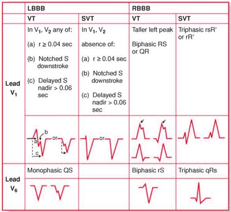 Wide Complex Tachycardia Ventricular Tachycardia Versus Images