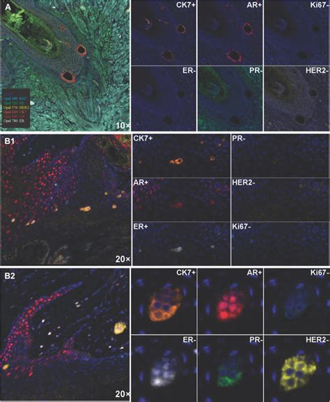 Toker Cell Hyperplasia In The Nipple Areolar Complex Of Transmasculine