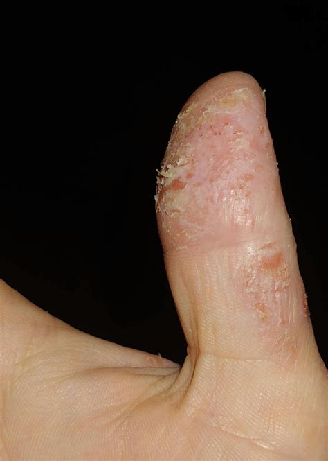 Skinesa® | Best Probiotic Supplements for Skin Health | Probiotic Pills