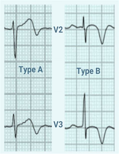 ECG patterns showing criteria and types of Wellens syndrome | Download ...