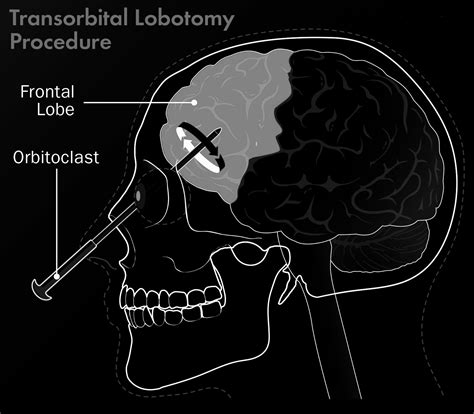 THE CONTROVERSIAL NEUROSURGERY: TRANSORBITAL LOBOTOMY