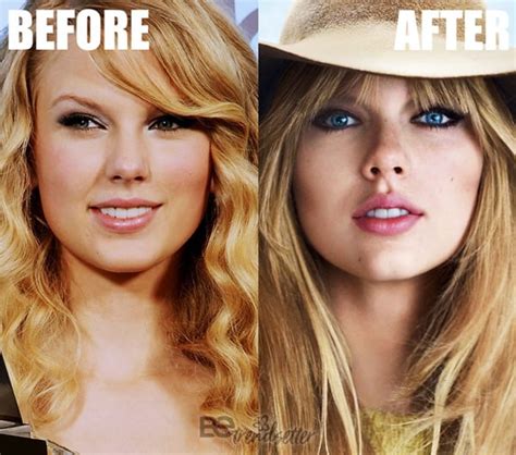 Taylor Swift Before And After Veneers