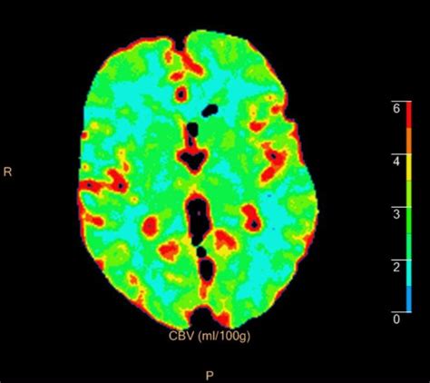 Ct Perfusion Lacunar Infarct Image