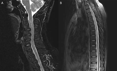 Frontiers | Case Report: Neuromyelitis Optica Spectrum Disorder With