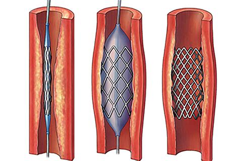 İlaçlı Stent Nedir Doç Dr Nihat ŞEN