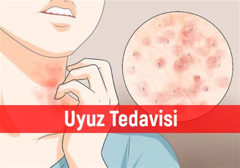 Uyuz Hastal Belirtileri Ve Tedavisi Tedavi Tc