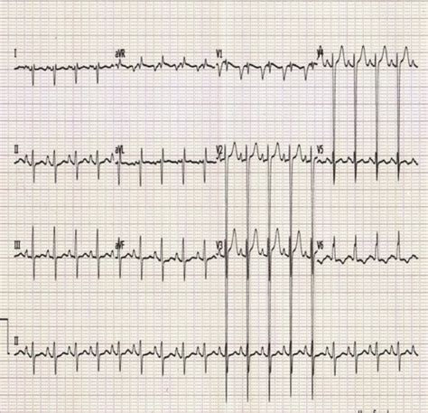 Complex Exam 4 Cardiac Crises Flashcards Quizlet