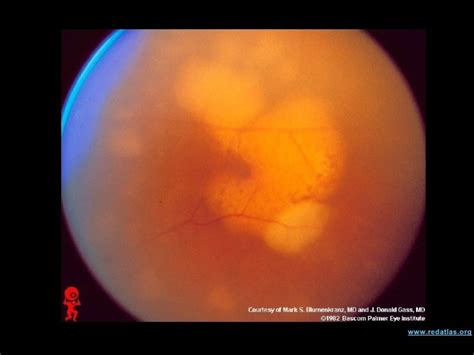 Linfoma Intraocular