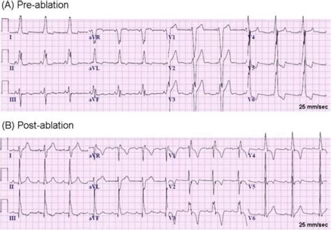 Twelve Lead Electrocardiogram A Pre Ablation There Is An Evidence Download Scientific