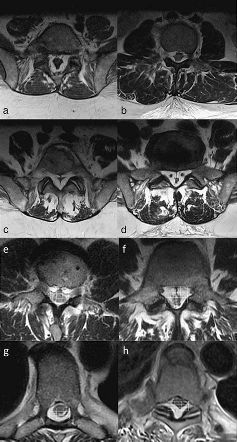 A D Axial T2 Weighted Mr Images Demonstrating Different Thecal Sac