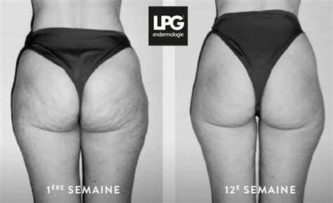 Lpg Endermologie Cellu M Soin Anti Cellulite Pack De S Ances