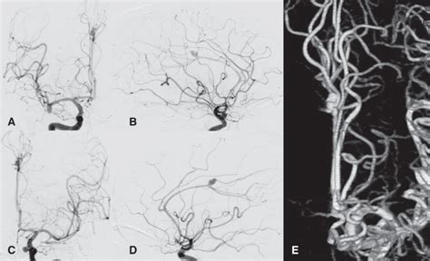 Preoperative Internal Carotid Angiograms A Anteriorposterior View Of Download Scientific