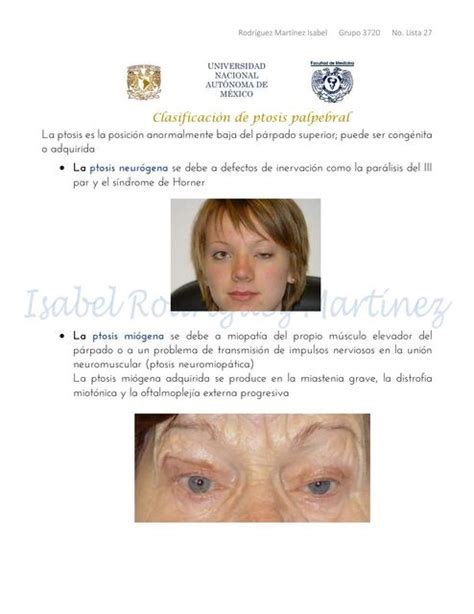 Clasificaci N De La Ptosis Palpebral Iovanny Cruz Ojeda Udocz